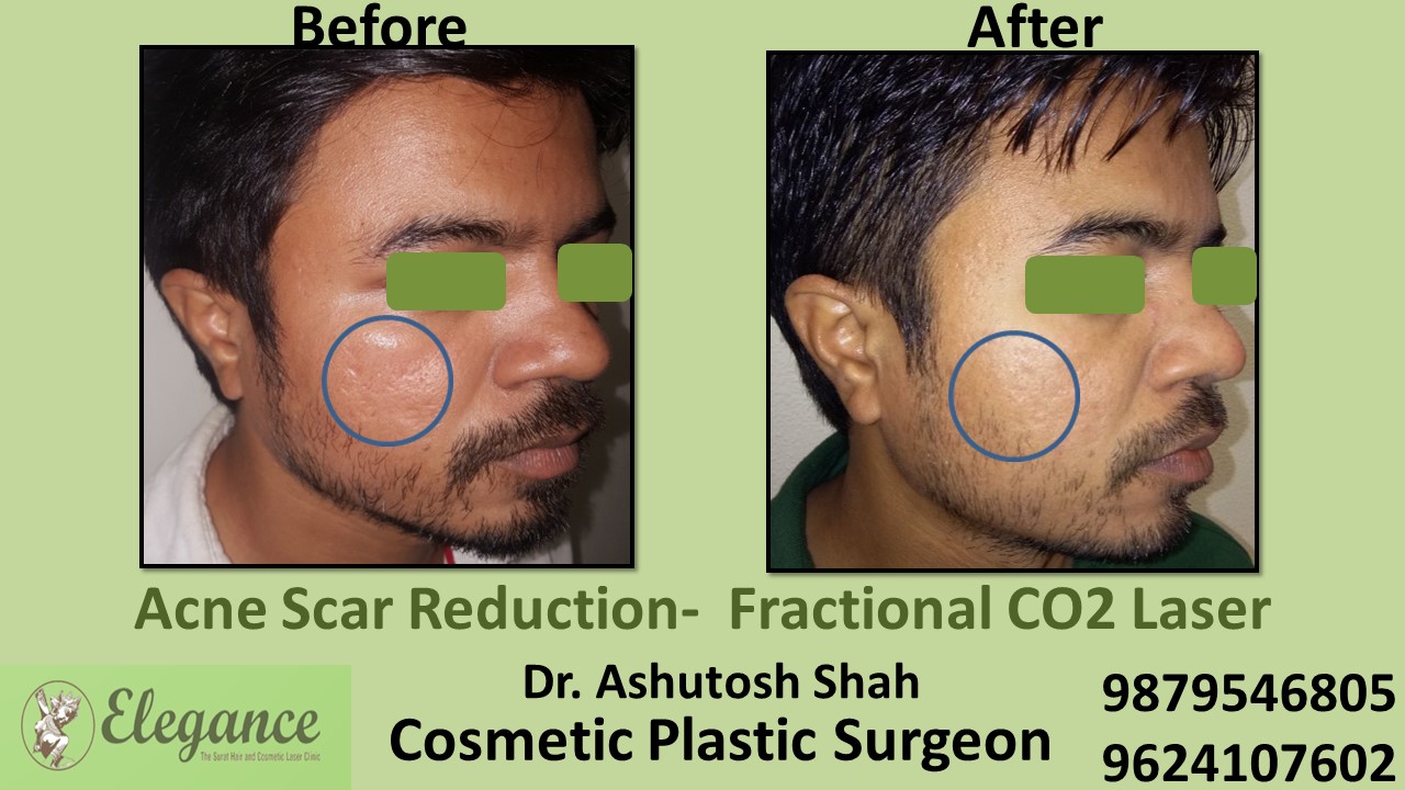 Acne scars- Co2 Fractional Laser Treatment in Valsad, Surat