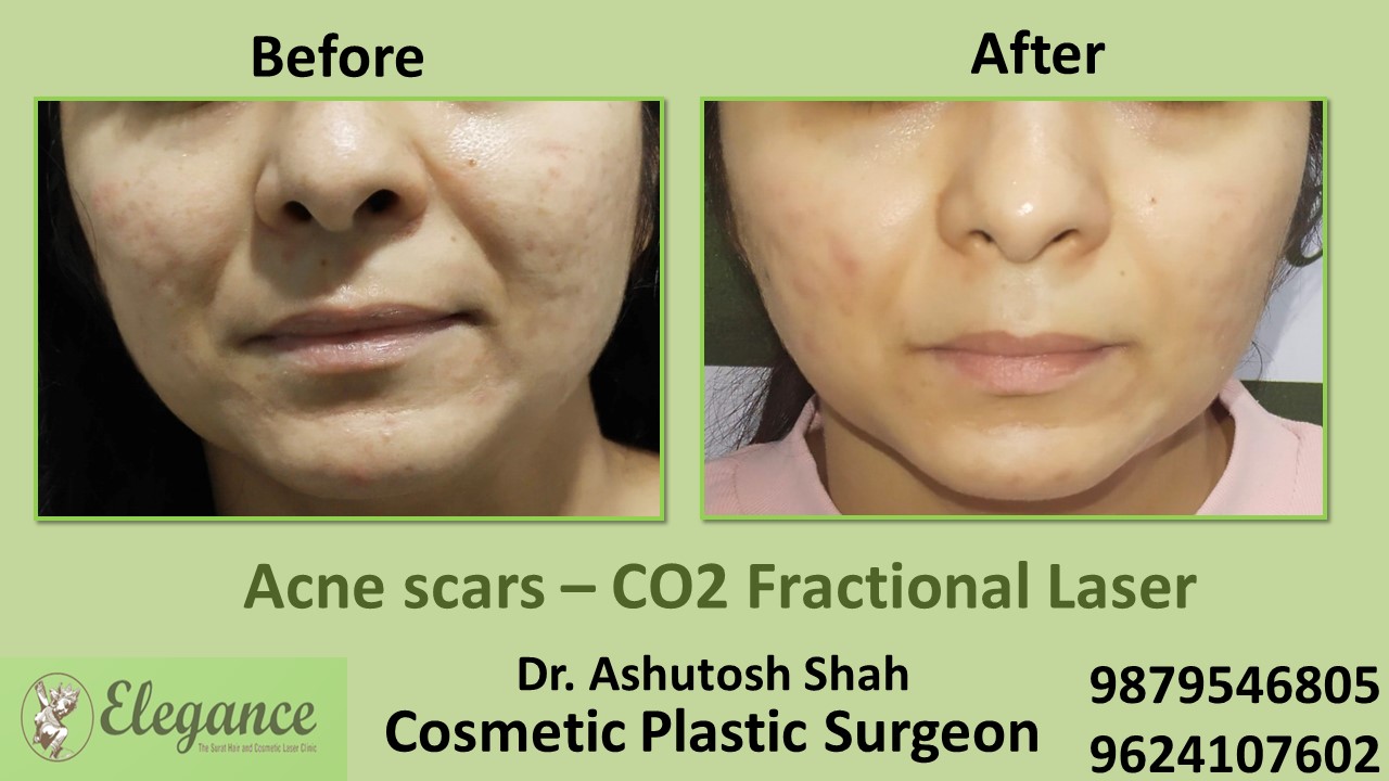 Acne scars- Co2 Fractional Laser Treatment in Valsad, Vapi, Surat