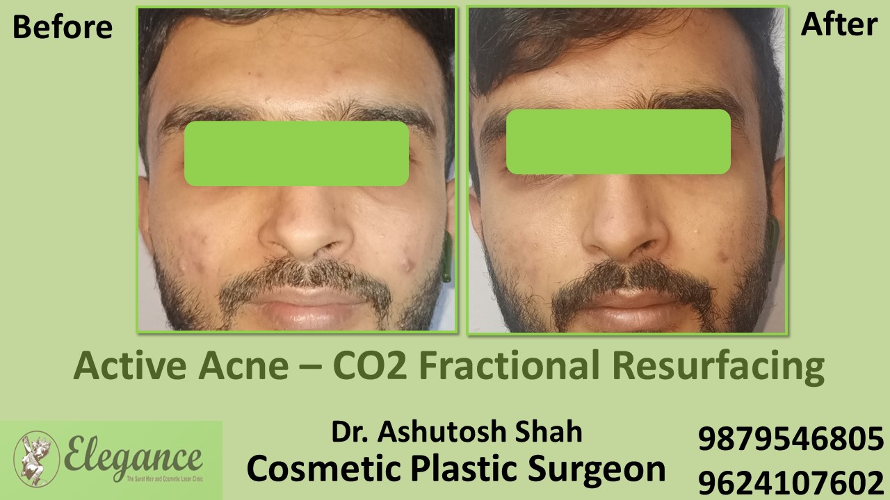 Acne scars- Co2 Fractional Laser Treatment in Vapi, Kim, Surat