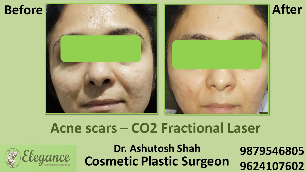 Acne scars- Co2 Fractional Laser Treatment in Vapi, Surat