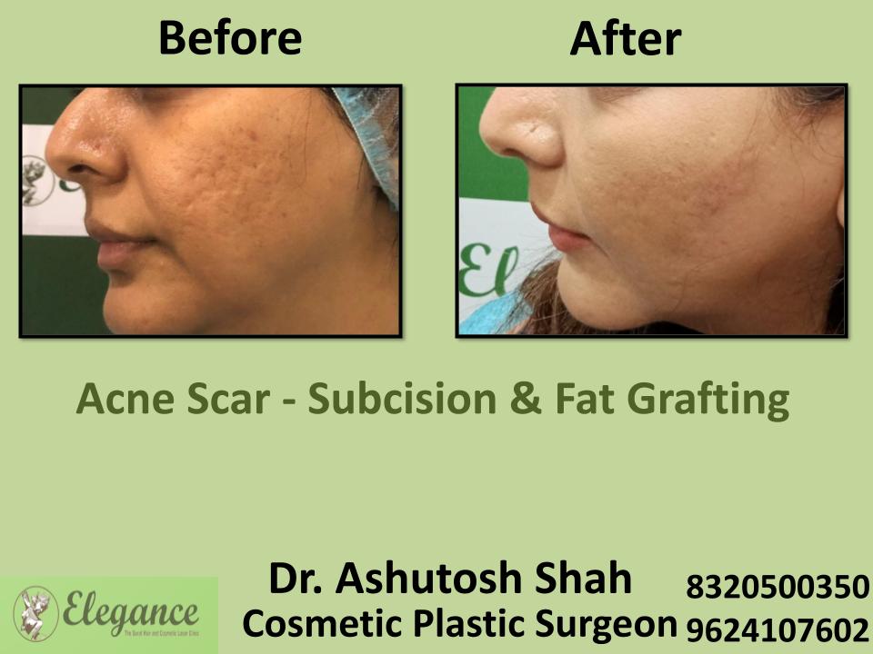 Face Acne Subcision and Fat Grafting, Marks From Acne, Nanpura,  Athwa, Udhna, Surat, Gujarat.