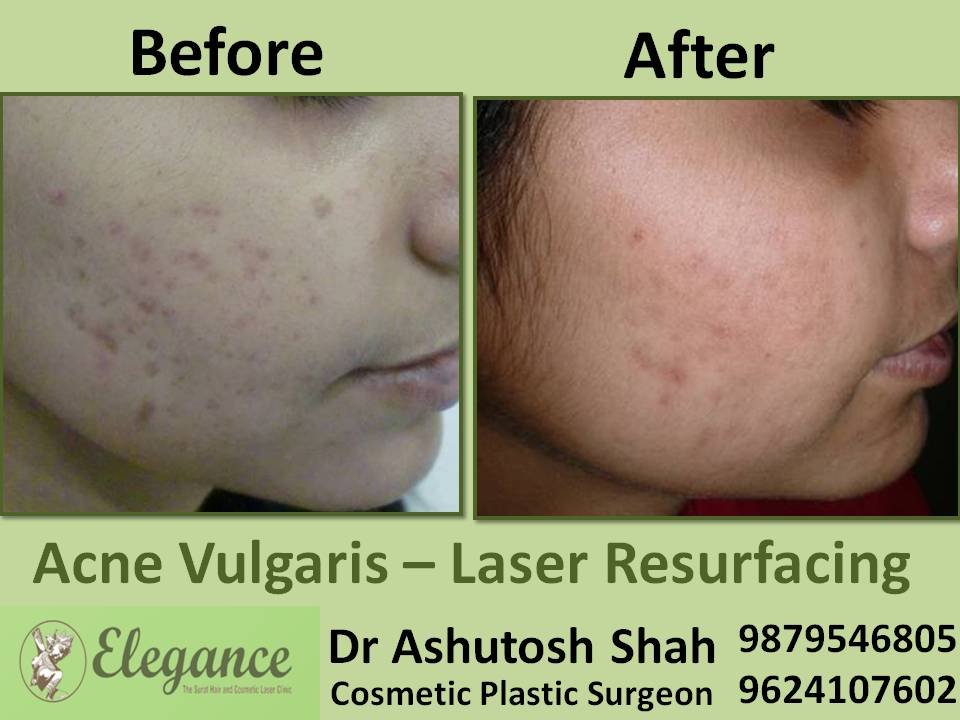 Laser Resurfacing Doctotor In Surat, Gujarat, India