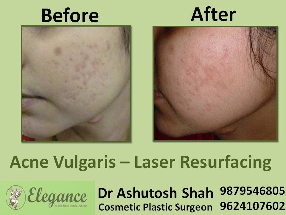 Laser Resurfacing Cost In Surat, Gujarat, India