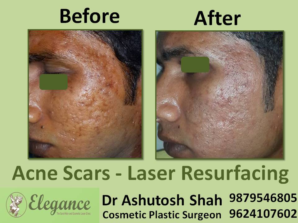 Laser Resurfacing Price In Surat, Gujarat, India