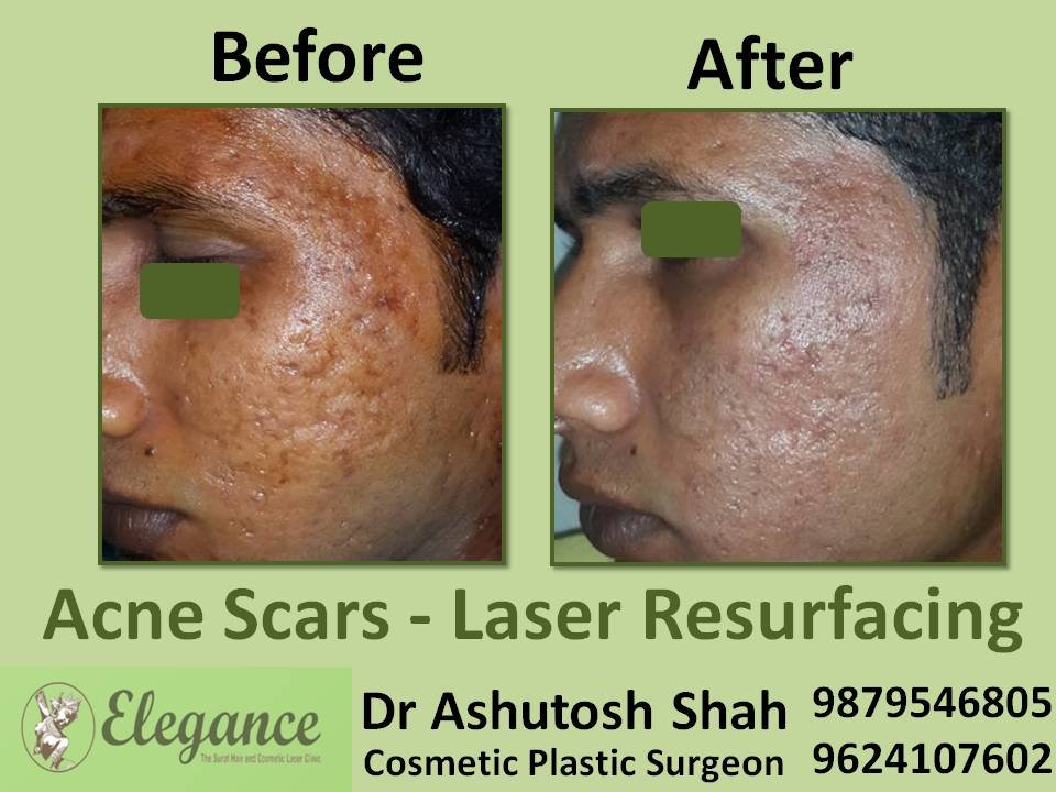 Acne and Pores treatment in Surat, Gujarat (India)