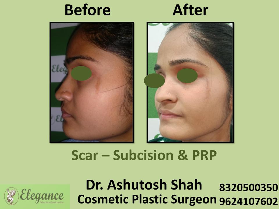 Scar, Subcision And Prp, Marks Left By Acne, Katargam, Athwa, Umra, Majura, Surat, Gujarat.
