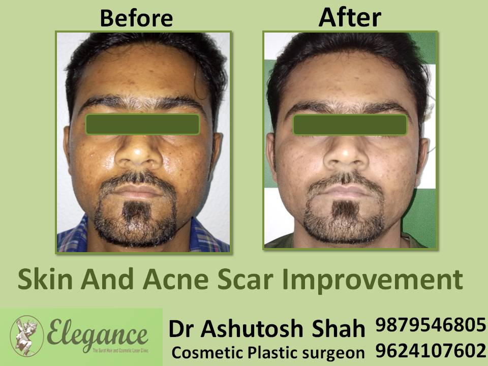 Skin and Acne Scar Improvement In Suart, Gujarat, India