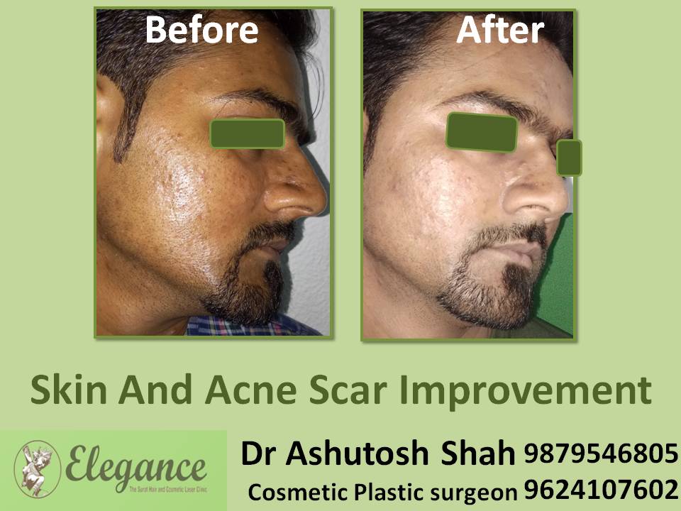 Skin And Acne Scar Improvement In Vapi, Gujarat, India