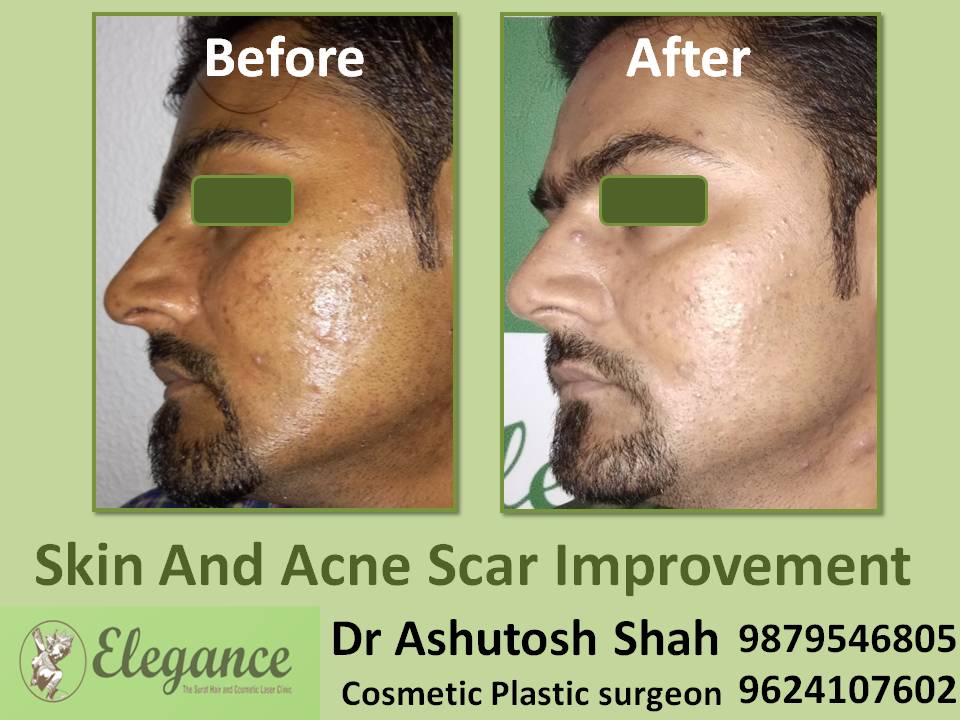 Skin And Acne Scar Improvement In Kutch, Gujarat, India