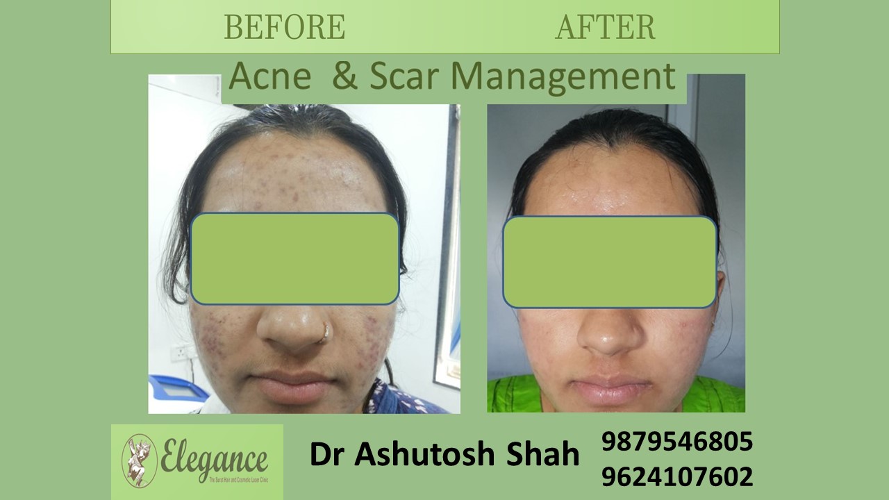 Acne Scar Management in Surat, Gujarat (India)