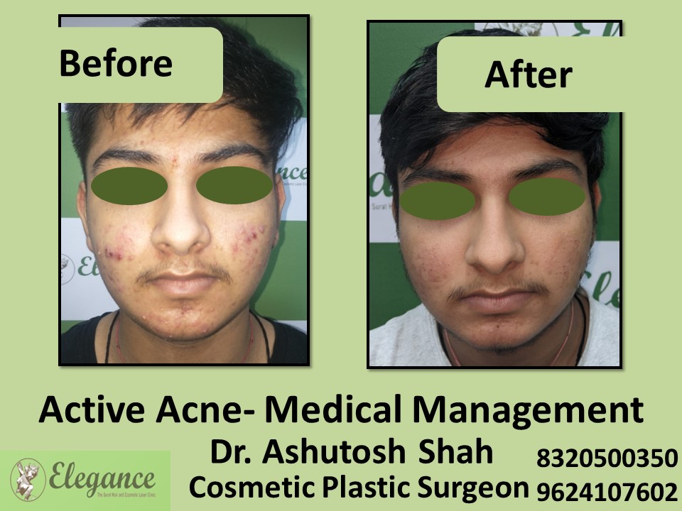 Acne Removal, Acne Treatment in Udhna, Vesu, Surat