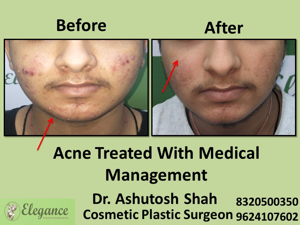 Acne Treated with Medical Management in Adajan, Surat