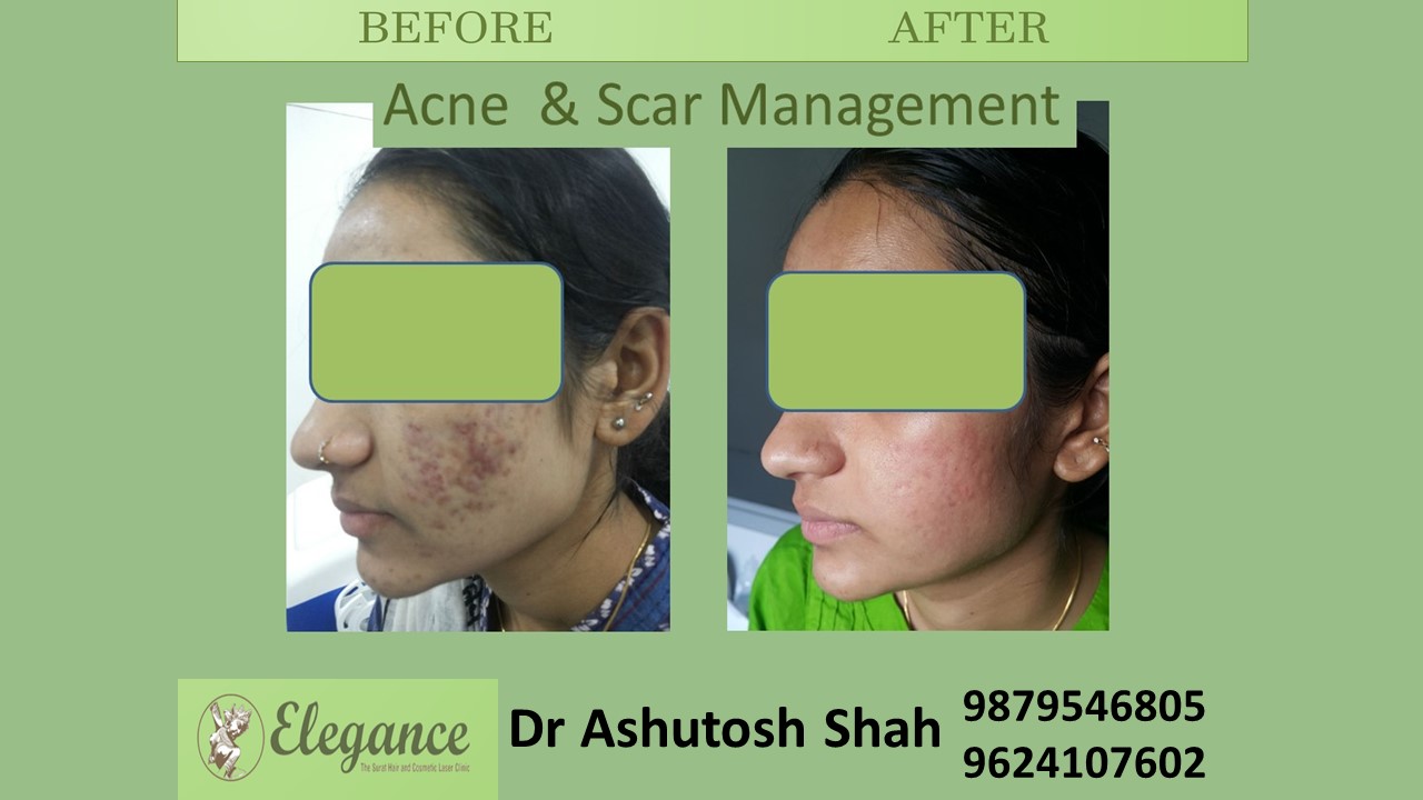 Acne Scar Management in Surat, Gujarat (India)