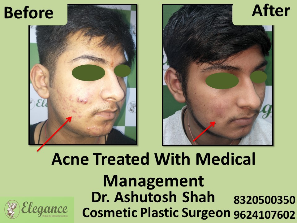 Acne Treatment with Medical in Vesu, Surat