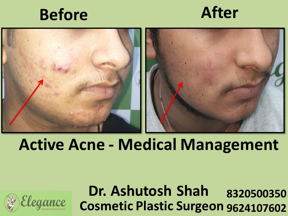 Active Acne, Medical Management Treatment in Vesu, Surat