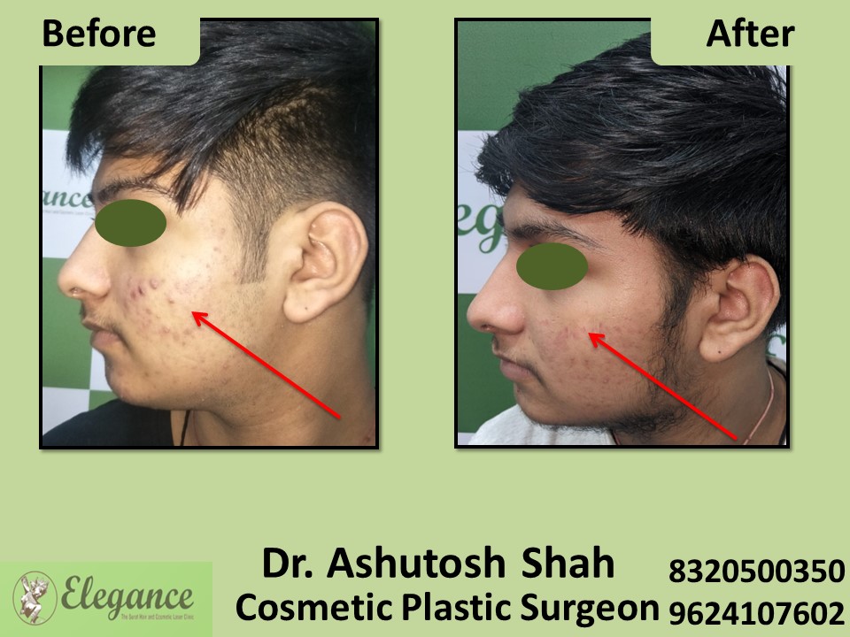 Acne Treatment, Skin Glow in Vesu, Surat