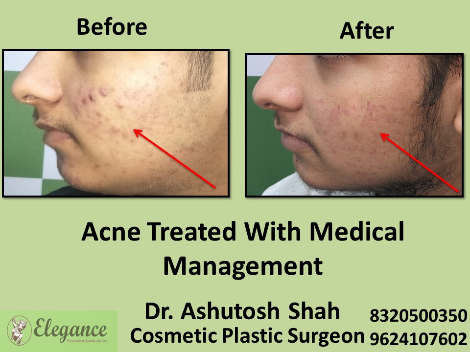 Acne Treated with Medical Management in Surat