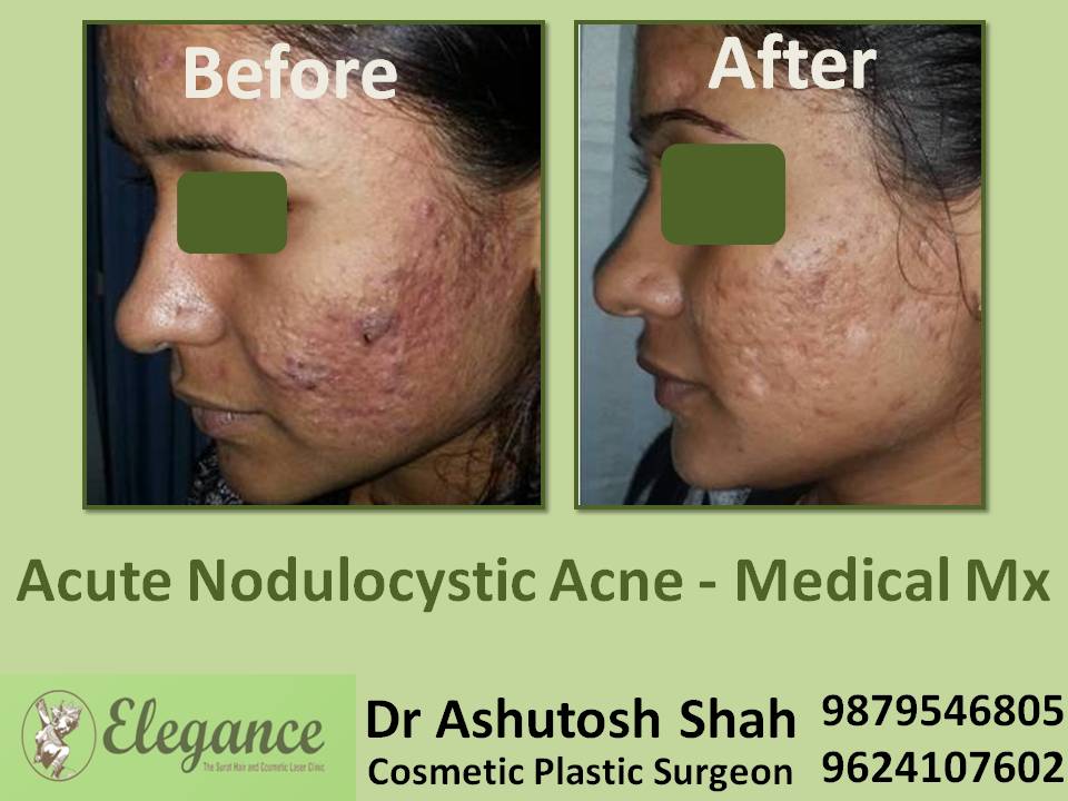 Acute Nodulocystic Acne Medical Mx In Surat, Gujarat, India
