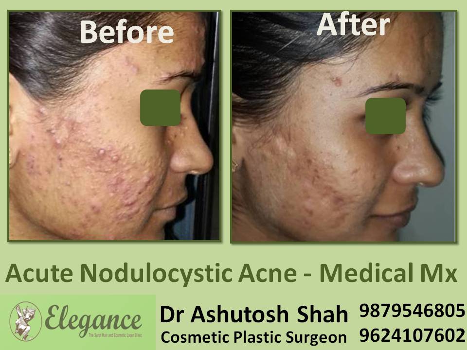 Acute Nodulocystic Acne Medical Mx Doctor In Surat, Gujarat, India