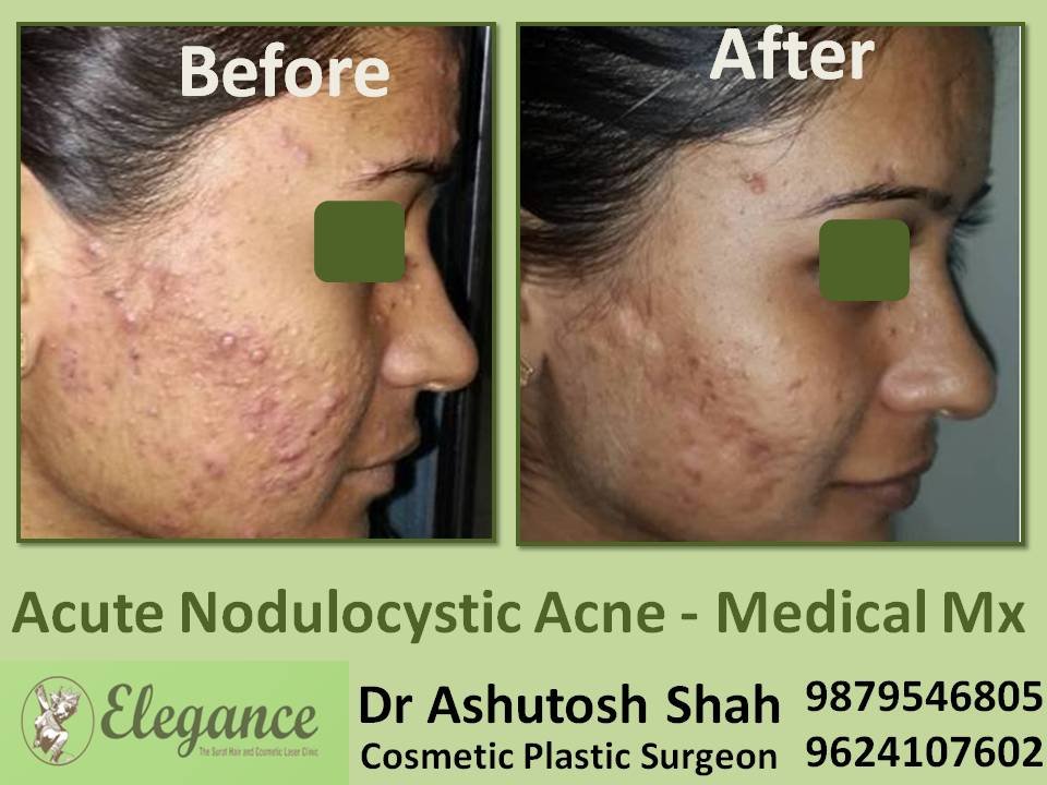 Acute Nodulocystic Acne Medical Mx Doctor In Surat, Gujarat, India