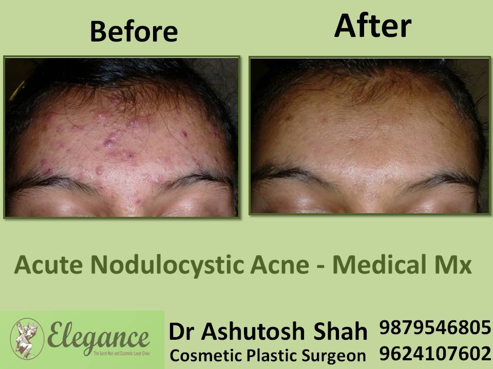 Acute Nodulocystic Acne Medical Mx Cost In Surat, Gujarat, India