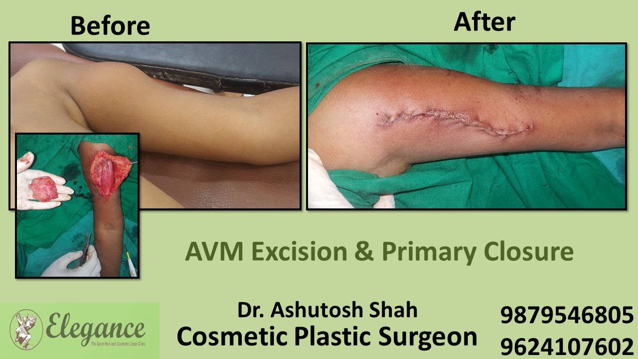 AVM Excision Treatment in Navsari, Surat