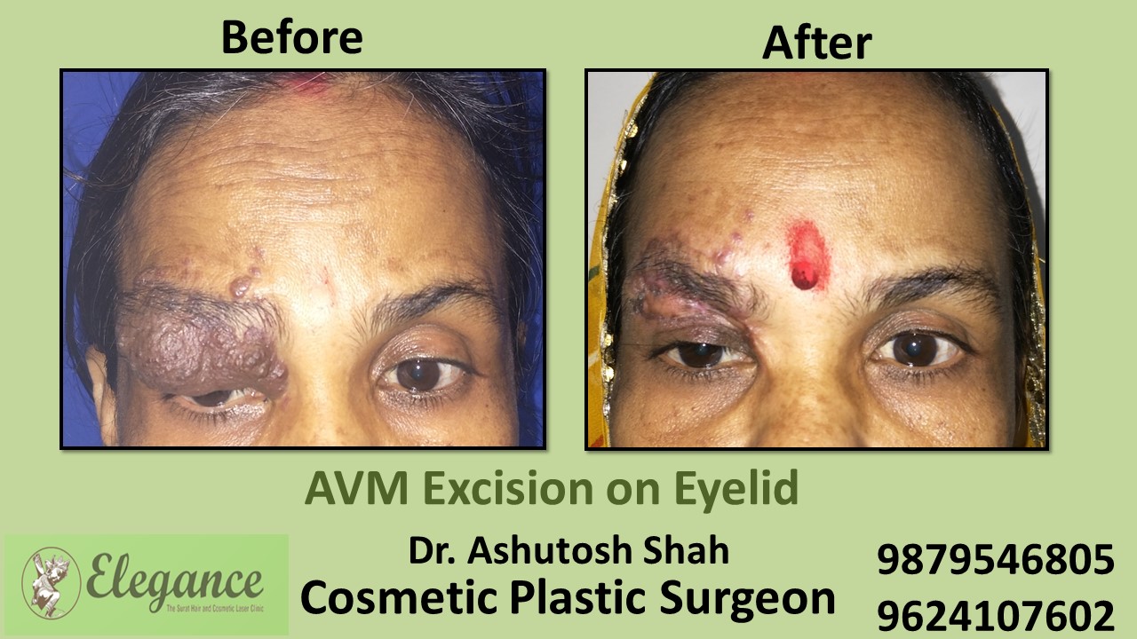 AVM Excision Treatment in Vapi, Surat