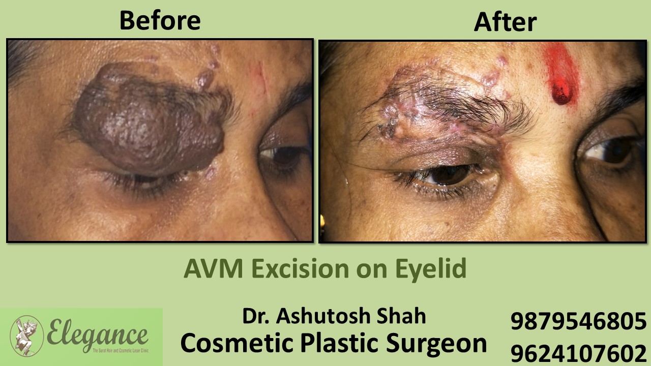 AVM Excision Treatment in Vapi, Valsad, Surat
