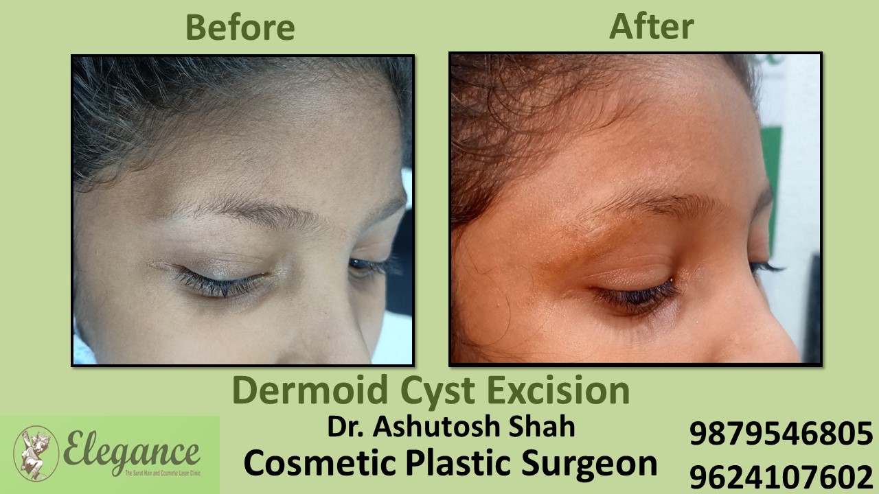 Dermoid Cyst Excision Treatment in Dumas, Hazira, VIP Road, Surat