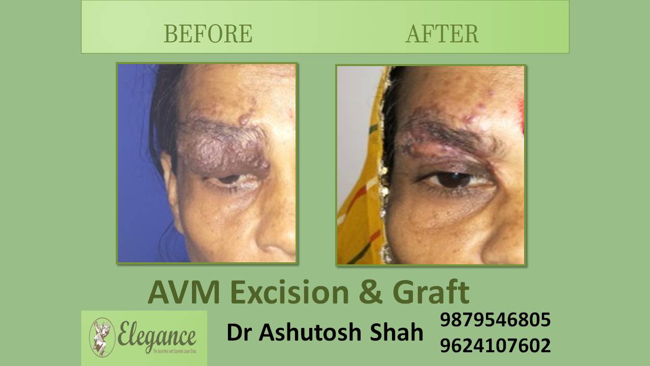 AVM Excision In Vapi, Gujarat, India