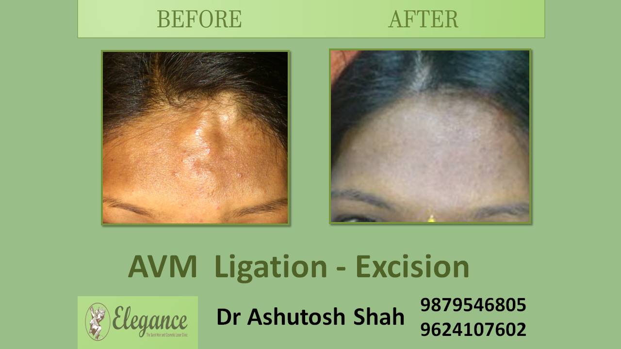 AVM Excision In Surat, Gujarat, India