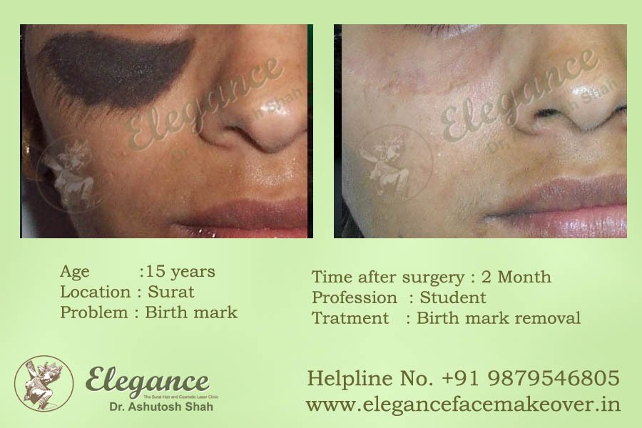 BirthMark Removal  in Surat, Gujarat (India)