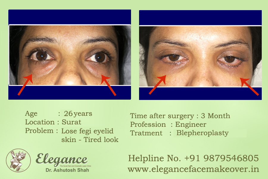 Eyelid or Blepharoplasty Surgery in Surat, Gujarat (India)