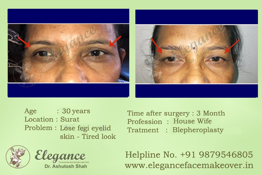 Eyelid or Blepharoplasty Surgery in Surat, Gujarat (India)