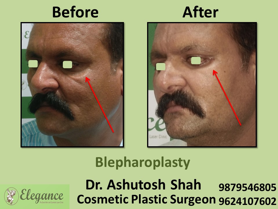 Blepheroplasty Treatment in Bardoli, Surat