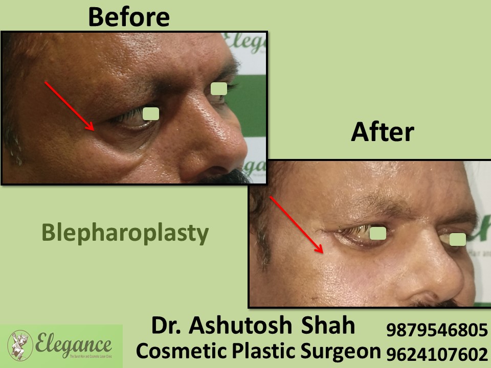 Blepharoplasty Treatment in Kosamba, Surat