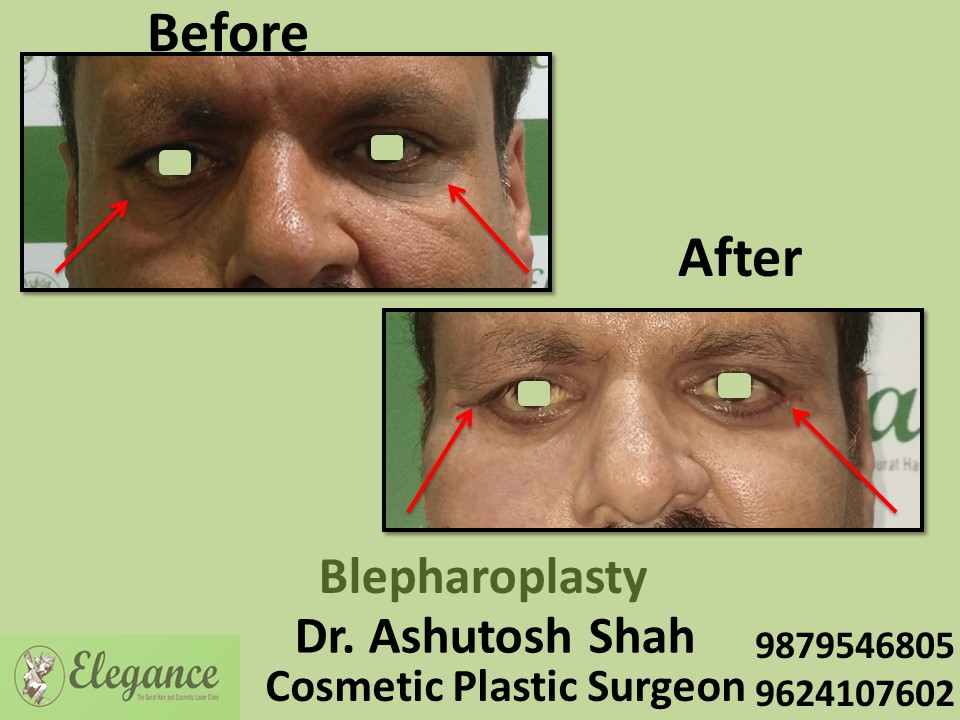 Blepharoplasty Treatment in Valsad, Surat