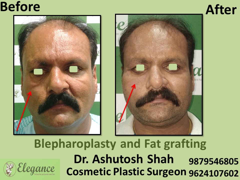 Blepharoplasty Treatment in Valsad, Vapi, Surat