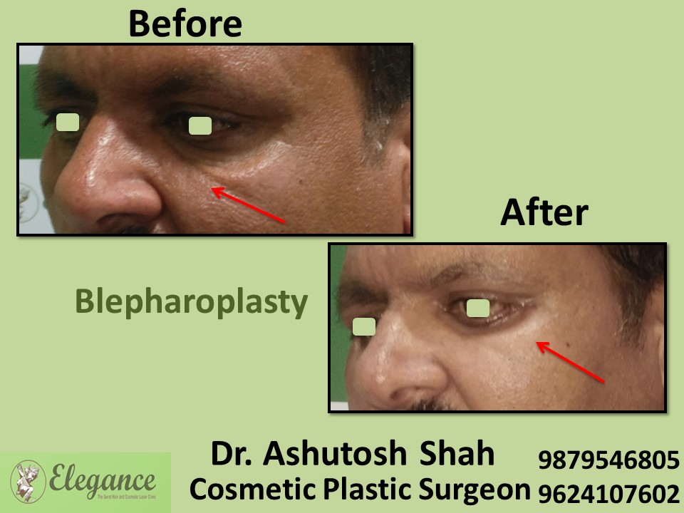Blepharoplasty Treatment in Vapi, Surat