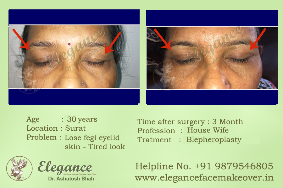Face Make Over Clinic in Surat, Gujarat, India