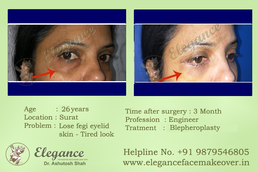Face Makeover Clinic in Surat, Gujarat, india