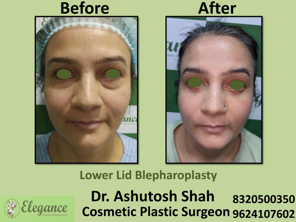 Lower Lid Bleapharoplasty, Baggy Eyelid Removal Surgery, Indore, Udaipur, Nasik, Mumbai, India.
