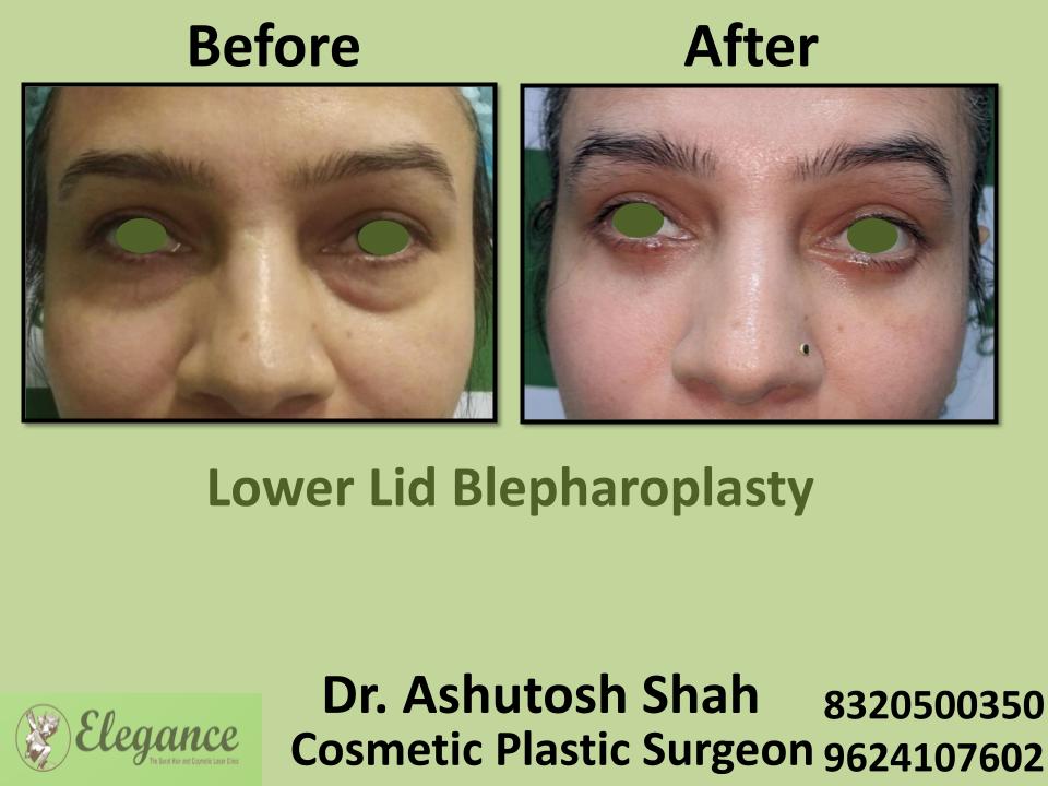 Lower Lid Bleapharoplasty, Eliminating Lower Eyelid Puffiness, Best Surgeons, Safe And Effective Surgery, Bharuch, Narmada, Tapi, gujarat.