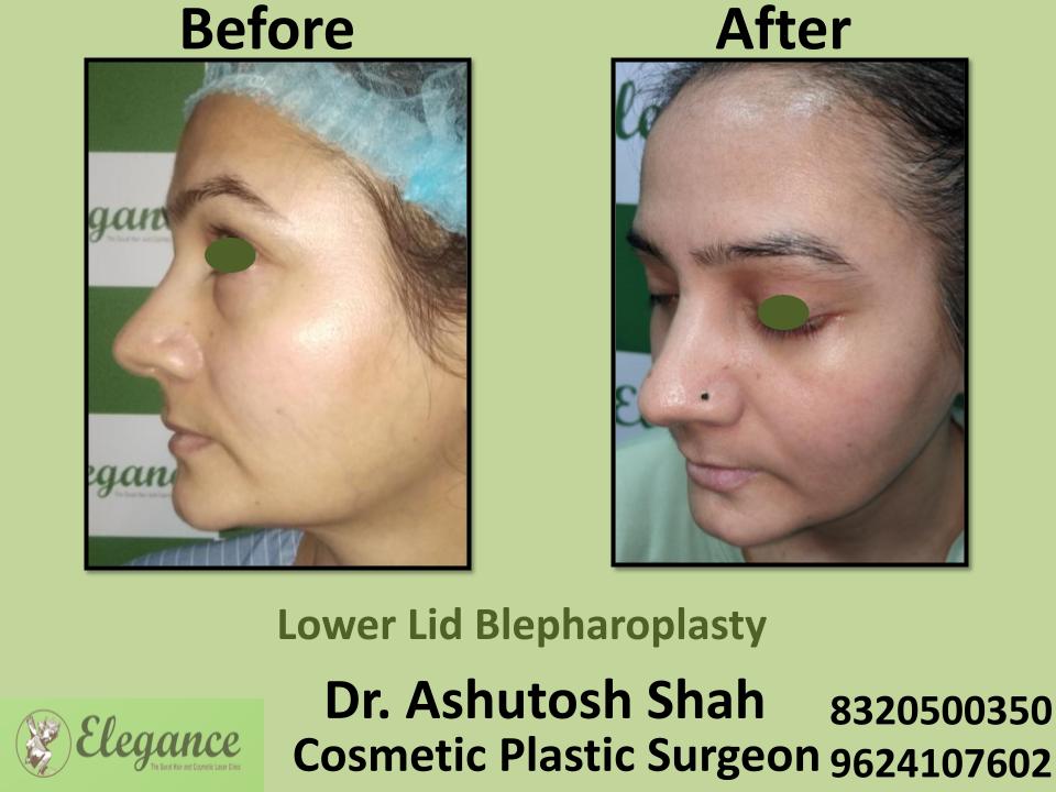Lower Lid Bleapharoplasty, Eyelid Bag Removal Surgery, Best  Doctors, Tapi, Rajkot, Narmada, Olpad, Kim, Surat, Gujarat.