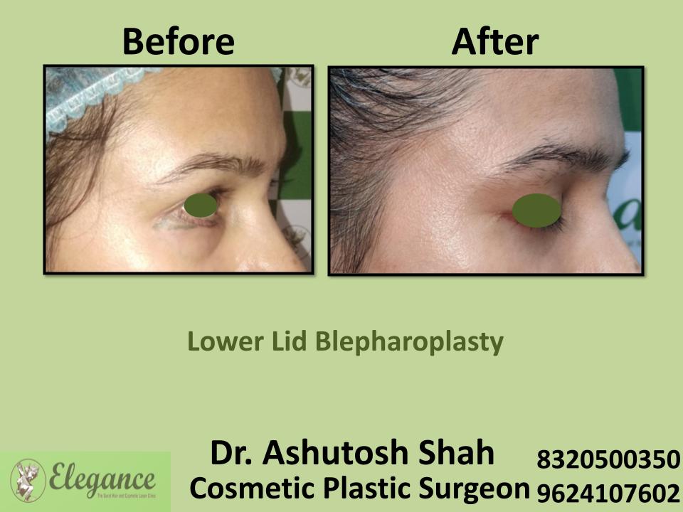 Lower Lid Bleapharoplasty, Eyelid Skin Tightenig, Surgery And Recovery, Bhachau, Indore, Mundra, Udaipur, India.