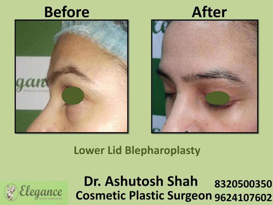 Lower Lid Bleapharoplasty, Lower Eyelid Fat Removal Surgery, Jamnagar, Vadodra, Kacch, Mundra, India.