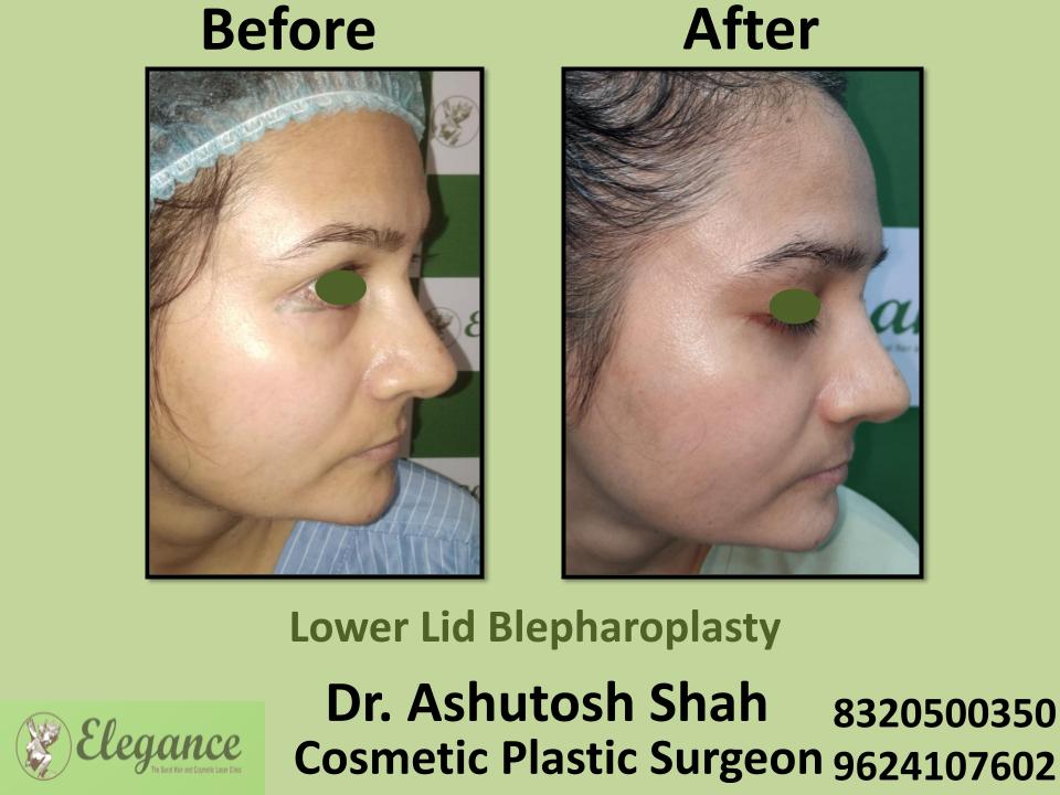 Lower Lid Bleapharoplasty, Surgery For Lower Eyelid Lift, Surgery Techniques, Mumbai, Nasik, Pune, Rajkot, India.