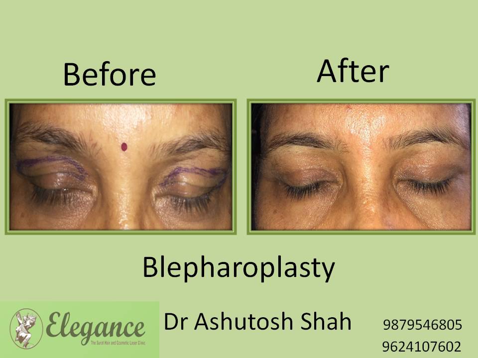 Blepharoplasty In Surat, Gujarat, India
