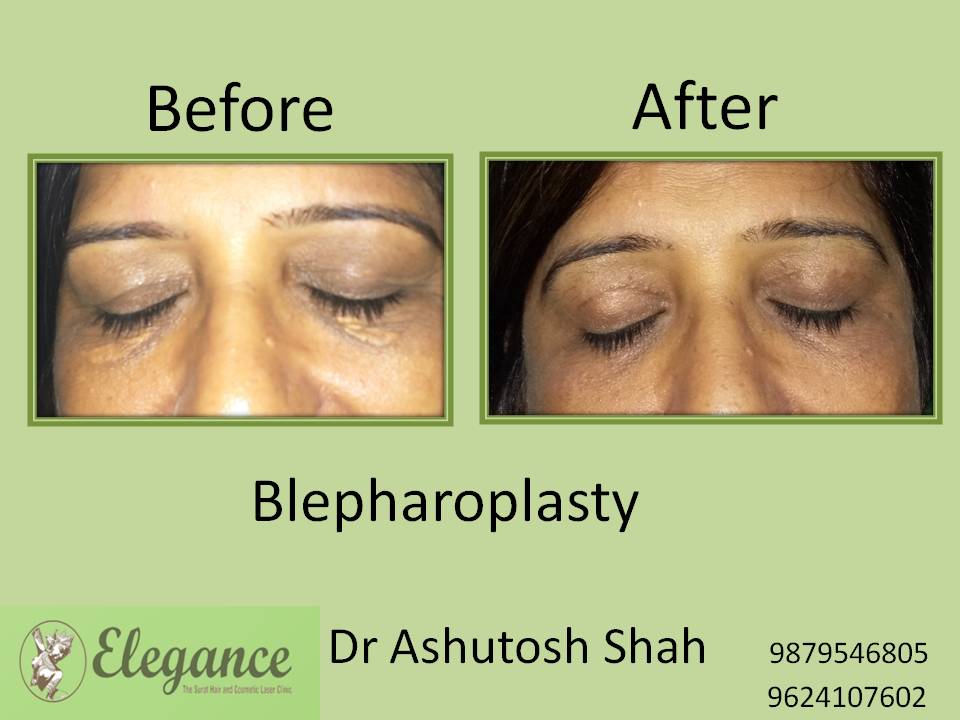 Blepharoplasty In Ratnagiri, Maharashtra, India