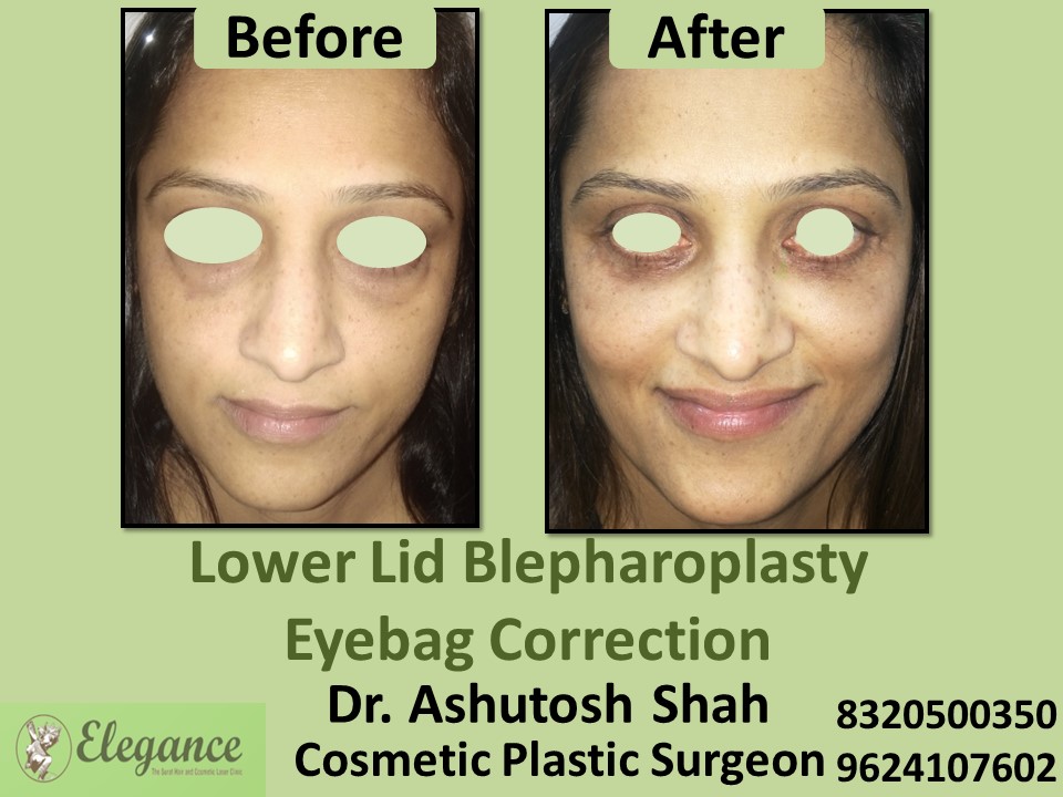 Lower Lid Blepharoplasty, Eye Correction in Vesu, Surat